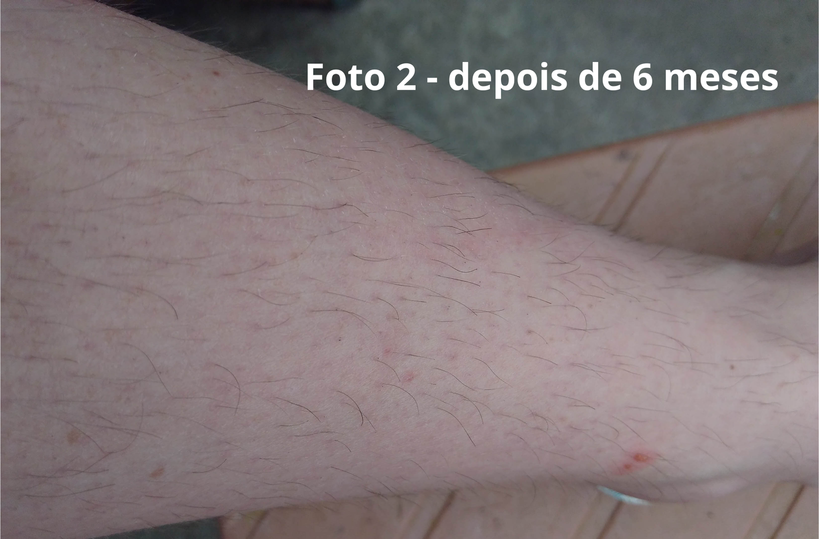 Foto 2 com 6 meses usando o sabonete de açafrão