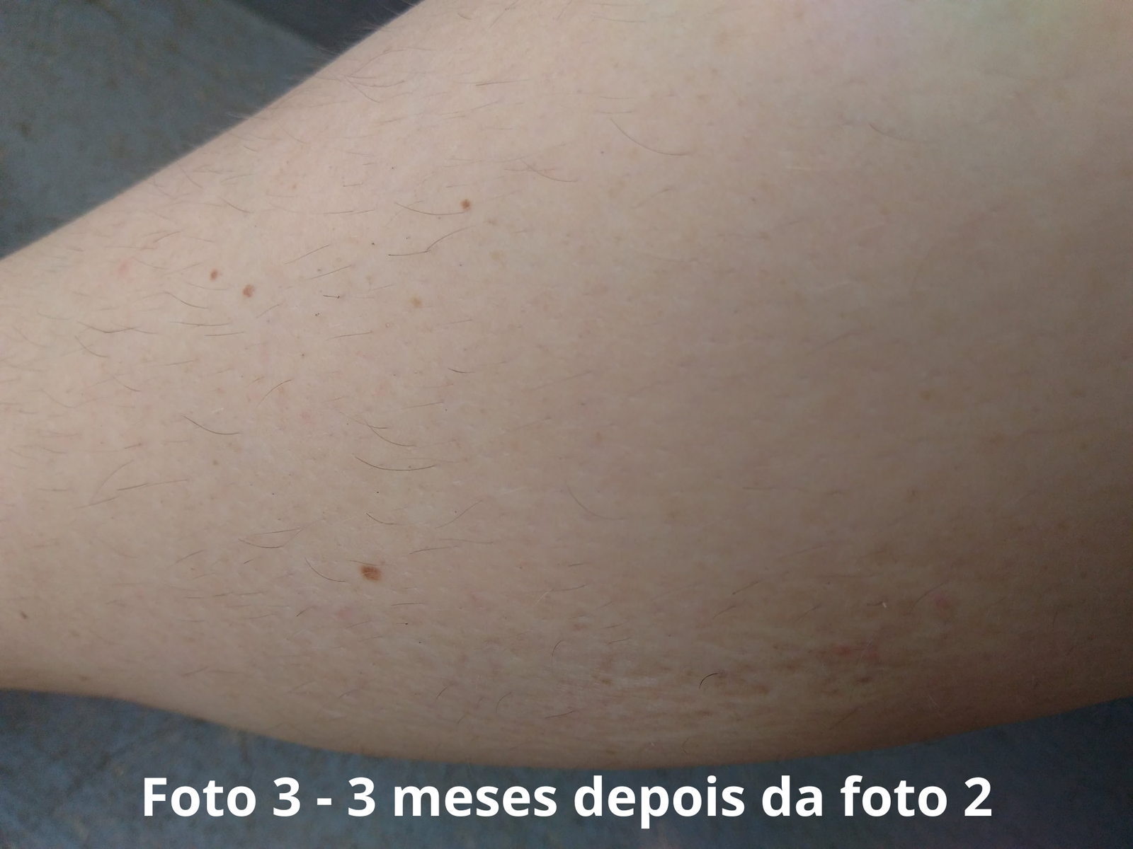 Foto 3, depois de 3 mesesda primeira - total de 9 meses de uso do sabonete de açafrão
