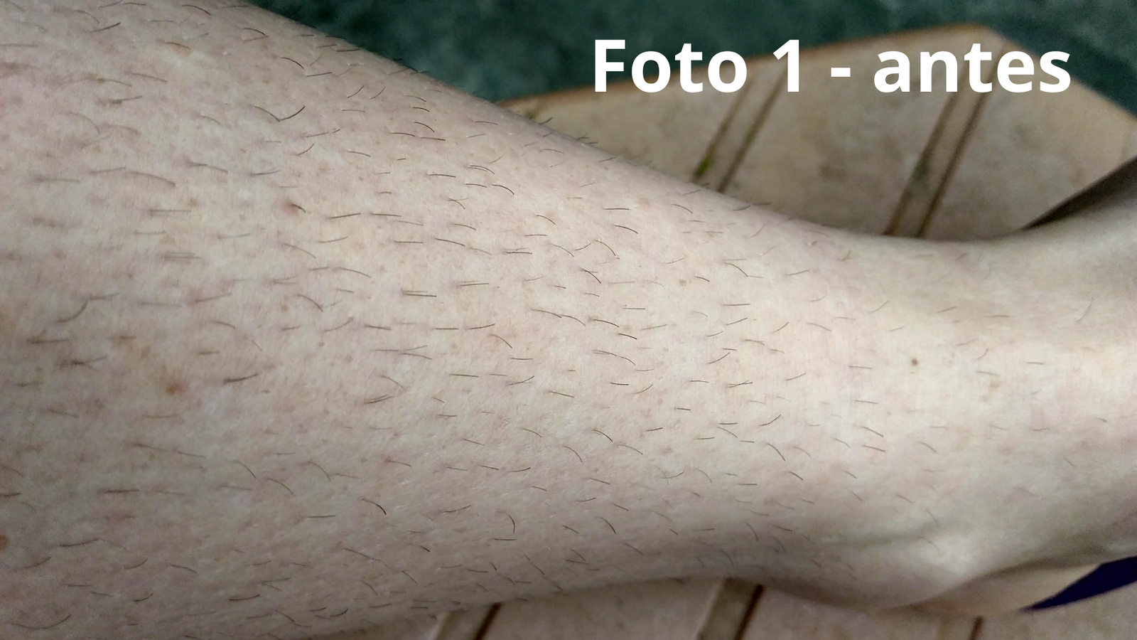 Foto 01 - Minha perna antes de iniciar o tratamento com o sabonete de açafrão